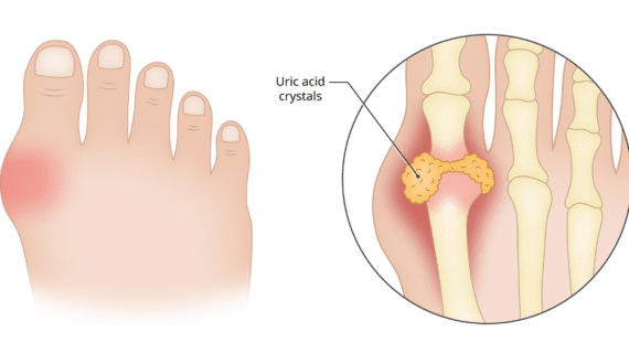 How to Remove Gout Crystals from Joint Without Side Effects