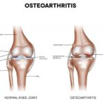 How I Cured My Osteoarthritis Naturally