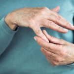 How to Cure Arthritis in Hand Without Therapy